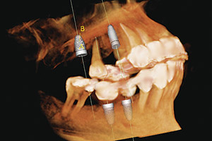 Dental Implants - Advanced Cosmetic Dentistry