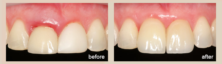 Options For Missing Teeth