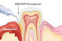 High-Tech Dentistry - Arestin Therapy - Advanced Cosmetic Dentistry