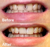 Advanced Cosmetic Dentistry - Cosmetic Bonding