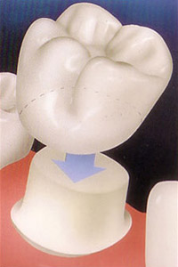 Porcelain Crowns, Onlays and Inlays