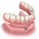 Dentures - Advanced Cosmetic Dentistry