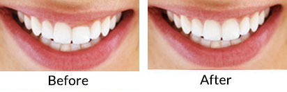 Laser Cosmetic Gum Treatment