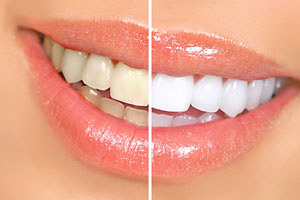 Teeth Whitening - Advanced Cosmetic Dentistry