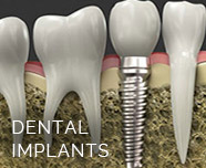 feature-dental-implants
