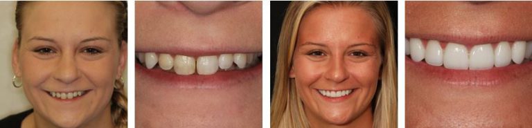 The Smile Makeover You Deserve In 2019!