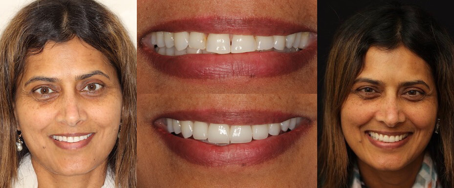 Dr. Vishali Aygari Portrait See the difference NYC smile design has made for Dr. Vishali Aygari