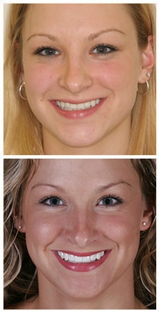 Before & After | Smile Design A photo of Jen a patient of Dr. Nosti who underwent smile design treatment