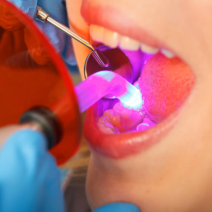 Dental Procedure An open mouth with a dental instrument working