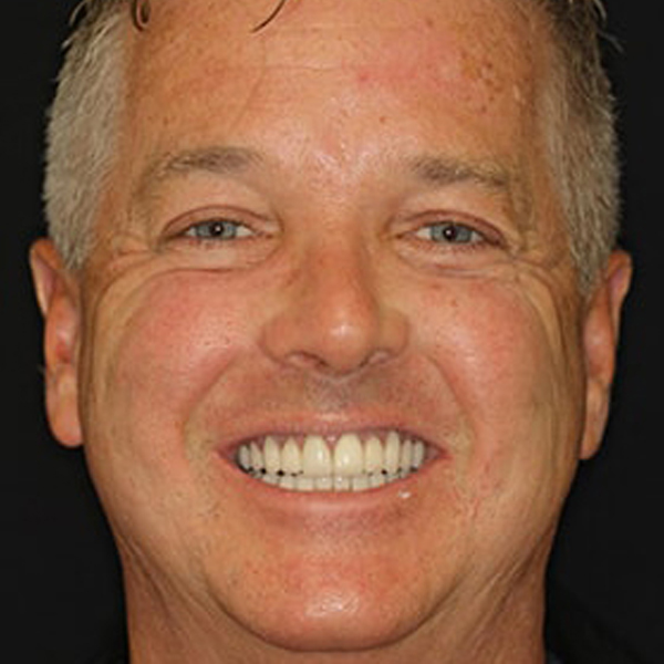 Restore your smile with our Full Mouth Rehabilitation Photo of after full mouth rehabilitation