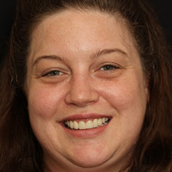Photo of actual patient who received porcelain crowns from New York dentist Dr. Nosti
