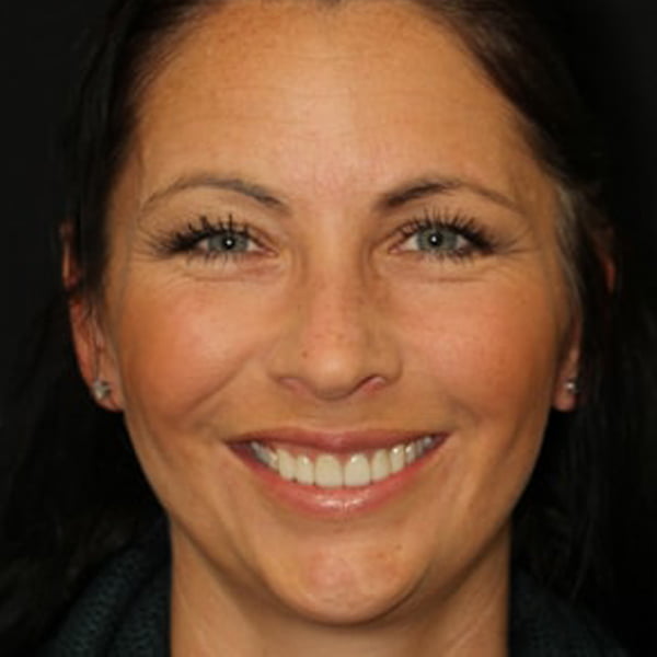 Photo of a patient who received Porcelain Veneers in New York City from Dr. Nosti