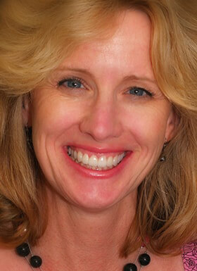 See the difference NYC smile design has made for Helen