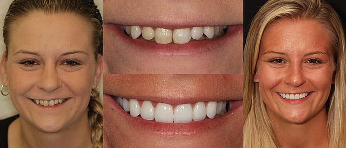 Brieanna - Actual Patient See the difference NYC smile design has made for Brieanna