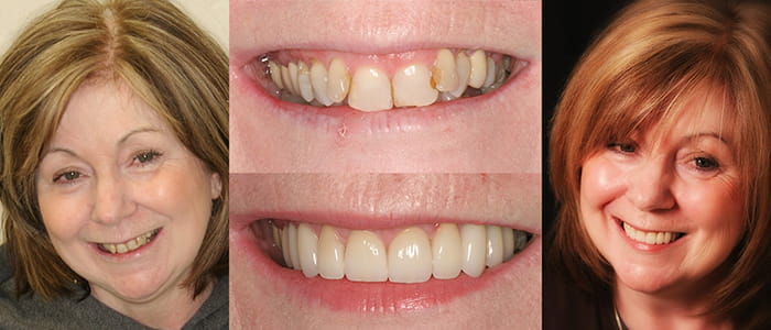 Lynda - Actual Patient See the difference NYC smile design has made for Lynda.