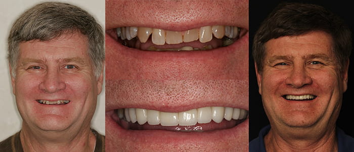 Mark - Actual Patient See the difference NYC smile design has made for Mark.
