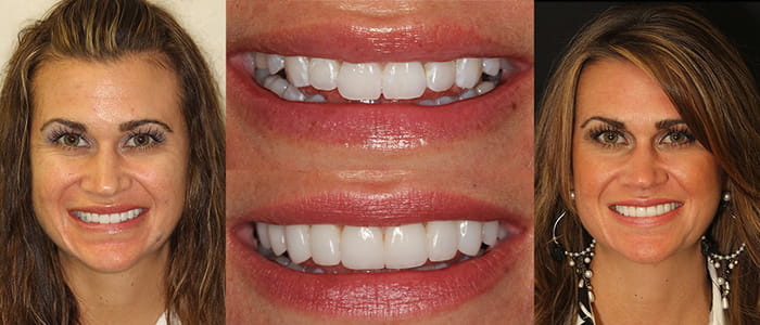Kristina - Actual Patient See the difference NYC smile design has made for Kristina.