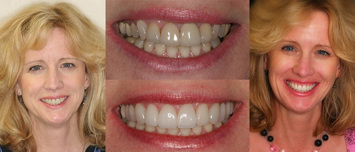 Helen - Actual Patient See the difference NYC smile design has made for Helen.