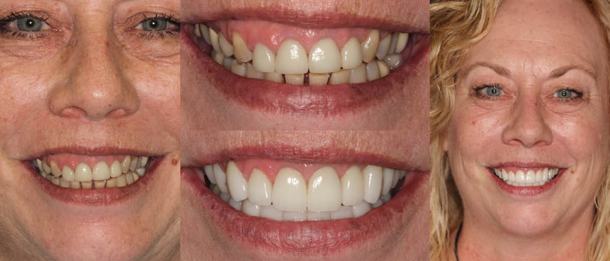 Joanne - Actual Patient See the difference NYC smile design has made for Joanne.