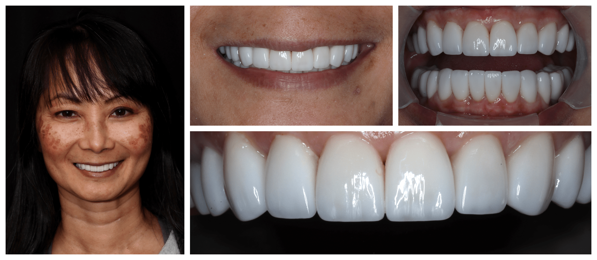 Smile with Confidence Before-and-after dental collage captures the heartwarming stories of transformed individuals, reflecting the expertise and care of our dental team