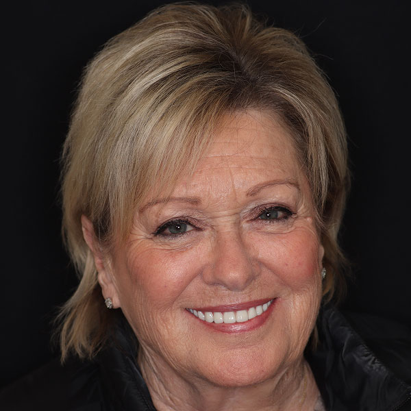 A dental implant is designed to look and function like a natural to Anatomy of the three parts of a dental implant post, abutment, and crown.