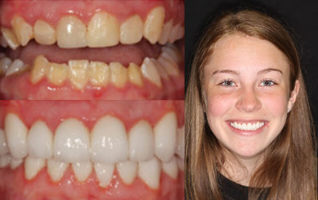 Alexandra Portrait See the difference NYC smile design has made for Alexandra