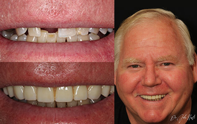 Art Portrait See the difference NYC smile design has made for Art