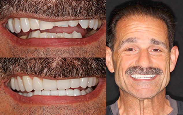 Dr. Ciccariello Portrait See the difference NYC smile design has made for Dr. Ciccariello