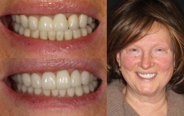 Galina Portrait See the difference NYC smile design has made for Galina