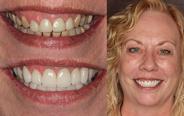Joann Portrait See the difference NYC smile design has made for Joann