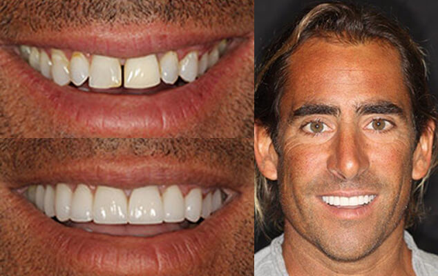 John Portrait See the difference NYC smile design has made for John
