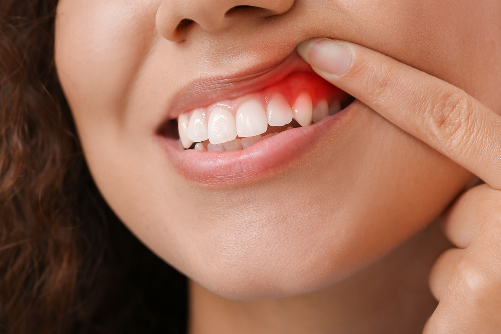 Side by Side Faces a woman showing her gingivitis