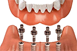 Snap-on Dentures